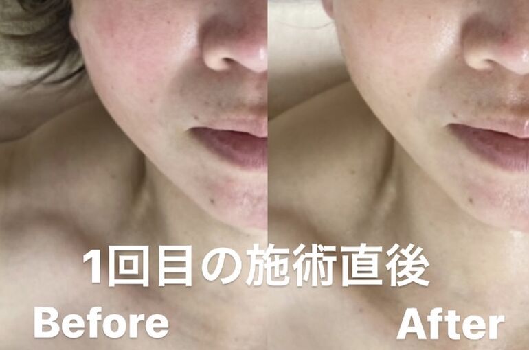 フェイシャルエステ