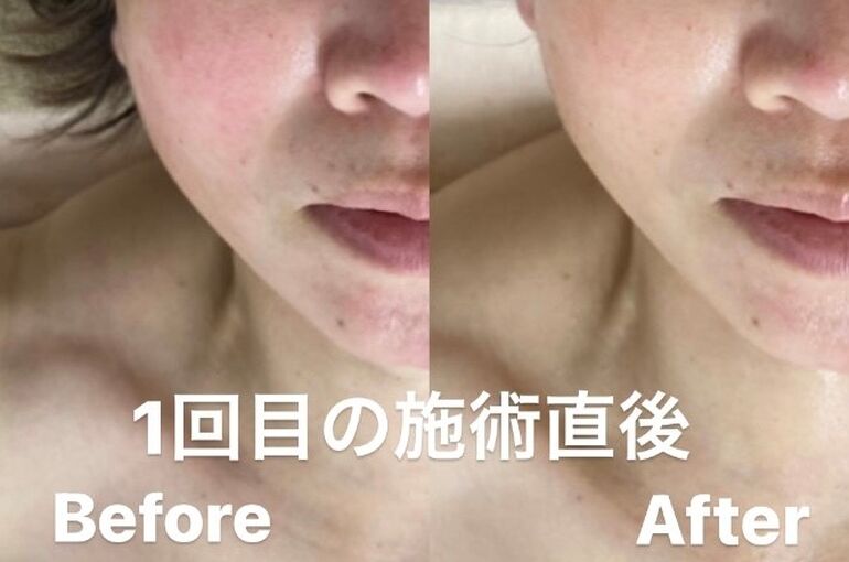 フェイシャル