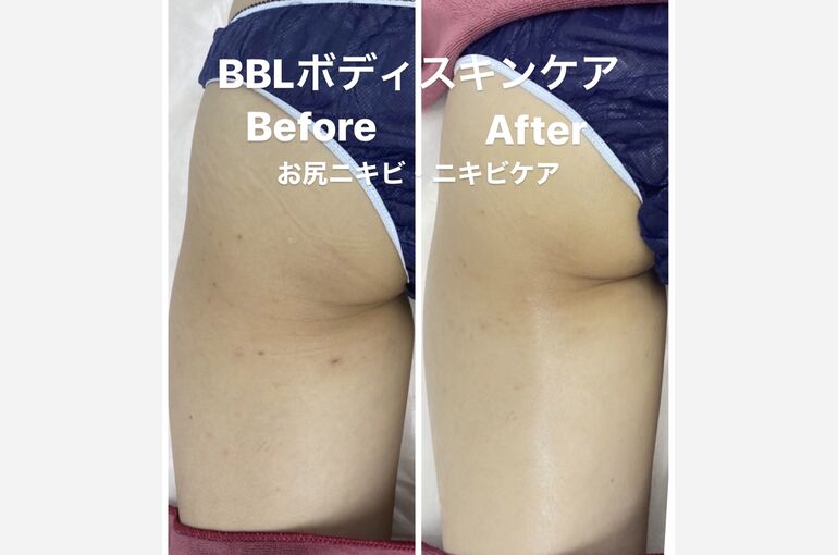 ニキビケア